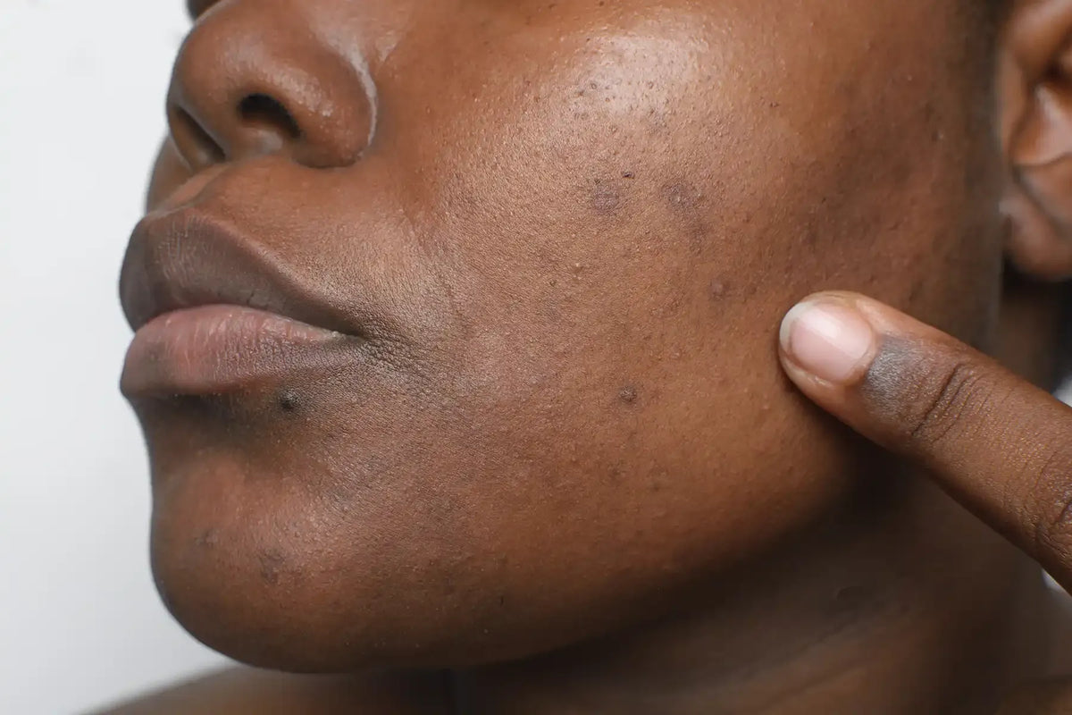 Dark Spots & Hyperpigmentation: What Actually Helps